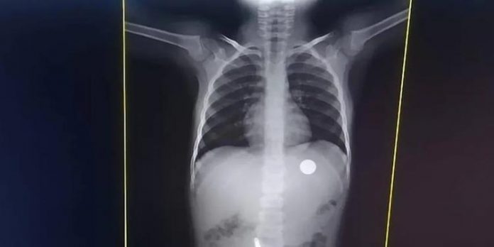 Menina de 4 anos engole moeda e tem dificuldade de respirar: ‘Mãe, vou morrer’