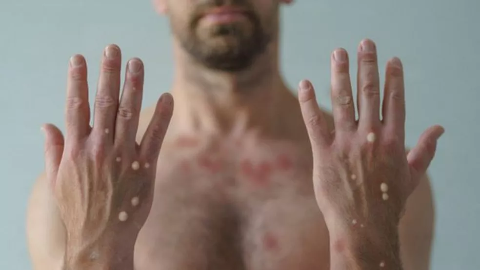 Monkeypox – Paciente com sintomas de varíola dos macacos esteve em Parintins, diz FVS-AM