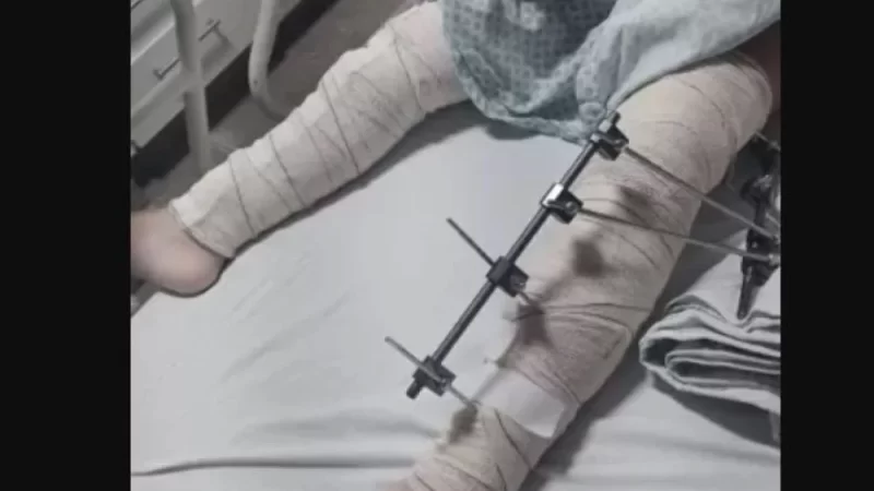 Menina de seis anos caí de bicicleta e tem pinos colocados em perna errada